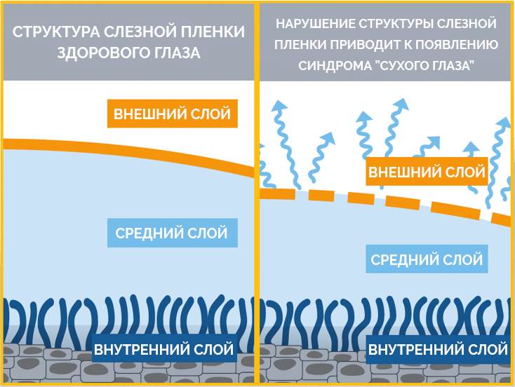 Симптомы синдрома «сухого глаза»